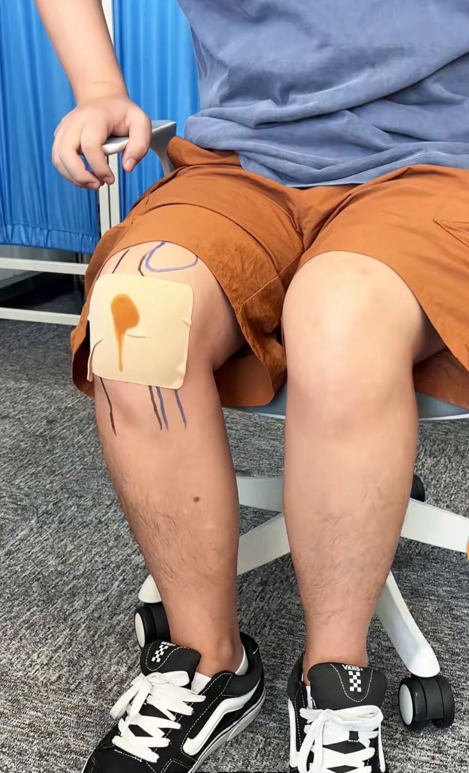 ADHESIVES FOR IMMEDIATE PAIN RELIEF